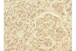 Immunohistochemistry of paraffin-embedded human pancreatic cancer using ABIN7167664 at dilution of 1:100 (Relaxin 3 Receptor 1 抗体  (AA 1-80))