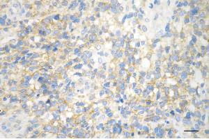 Immunohistochemistry was performed on paraffin-embedded human glioblastoma using huntingtin antibody (ABIN7799005), 1:200). (Recombinant Huntingtin 抗体)