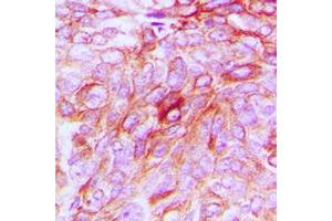 Immunohistochemical analysis of Phospholipase D4 staining in human breast cancer formalin fixed paraffin embedded tissue section. (Phospholipase D4 抗体  (C-Term))
