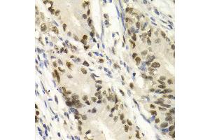 Immunohistochemistry of paraffin-embedded Human gastric cancer using KPNA4 antibody at dilution of 1:100 (x400 lens).