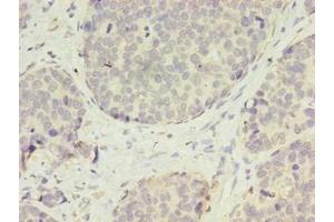 Immunohistochemistry of paraffin-embedded human gastric cancer using ABIN7175400 at dilution of 1:100 (Vasohibin 2 抗体  (AA 1-156))