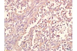 paraformaldehyde-fixed, paraffin embedded human lung carcinoma tissue, Antigen retrieval by boiling in sodium citrate buffer(pH6) for 15min, Block endogenous peroxidase by 3% hydrogen peroxide for 30 minutes, Blocking buffer (normal goat serum) at 37°C for 20min, Antibody incubation with Rabbit Anti-IL12 Polyclonal Antibody, Unconjugated  at 1:500 overnight at 4°C, followed by a conjugated secondary and DAB staining (IL12 抗体  (AA 51-150))