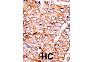 Formalin-fixed and paraffin-embedded human cancer tissue reacted with the primary antibody, which was peroxidase-conjugated to the secondary antibody, followed by AEC staining.