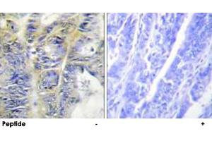 Immunohistochemistry analysis of paraffin-embedded human colon carcinoma tissue using COL4A5 polyclonal antibody . (COL4a5 抗体)