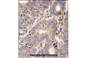 Formalin-fixed and paraffin-embedded human hepatocarcinoma tissue reacted with CARS2 antibody (C-term) (ABIN392315 and ABIN2841965) , which was peroxidase-conjugated to the secondary antibody, followed by DAB staining. (CARS2 抗体  (C-Term))