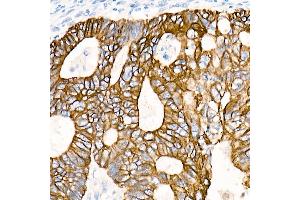Immunohistochemistry of paraffin-embedded Human colon carcinoma using Cytokeratin 19 (KRT19) antibody (ABIN7268099) at dilution of 1:100 (40x lens). (Cytokeratin 19 抗体)