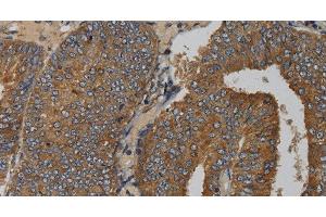 Immunohistochemistry of paraffin-embedded Human colon cancer tissue using MAS1 Polyclonal Antibody at dilution 1:50 (MAS1 抗体)