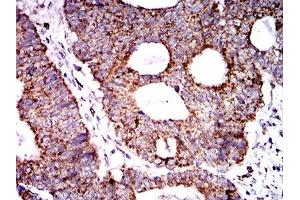 Immunohistochemical analysis of paraffin-embedded rectum cancer tissues using SOD2 mouse mAb with DAB staining. (SOD2 抗体  (AA 1-222))