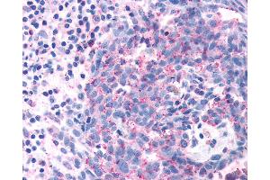 Anti-OR2A4 antibody IHC of human Skin, Melanoma. (OR2A4 抗体  (Extracellular Domain))