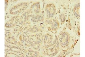 Immunohistochemistry of paraffin-embedded human breast cancer using ABIN7171326 at dilution of 1:100 (TAGAP 抗体  (AA 97-260))