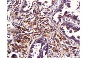 Formalin-fixed and paraffin embedded human lung carcinoma labeled with Anti-MDR1/p-GP/CD243 Polyclonal Antibody , Unconjugated 1:200 at 1:200, followed by conjugation to the secondary antibody and DAB staining (ATP-Binding Cassette, Sub-Family B (MDR/TAP), Member 1B (ABCB1B) (AA 21-100) 抗体)