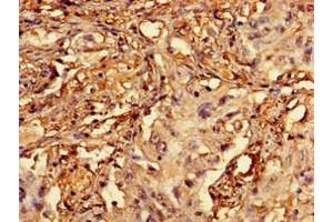 Immunohistochemistry of paraffin-embedded human lung cancer using ABIN7167421 at dilution of 1:100 (RCBTB2 抗体  (AA 1-200))