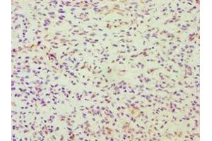 Immunohistochemistry of paraffin-embedded human breast cancer using ABIN7164363 at dilution of 1:100 (DDX5 抗体  (AA 1-290))