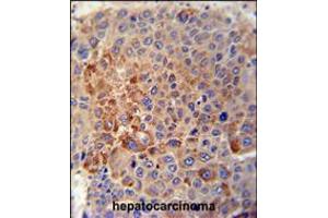 GPLD1 Antibody immunohistochemistry analysis in formalin fixed and paraffin embedded human hepatocarcinoma tissue followed by peroxidase conjugation of the secondary antibody and DAB staining. (GPLD1 抗体  (C-Term))