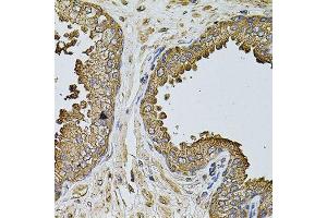 Immunohistochemistry of paraffin-embedded human prostate using MTIF3 antibody (ABIN5974622) at dilution of 1/100 (40x lens). (MTIF3 抗体)
