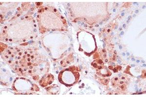 Immunohistochemistry of paraffin-embedded Human thyroid cancer using S100A5 Polyclonal Antibody at dilution of 1:100 (40x lens). (S100A5 抗体)