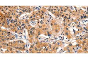 Immunohistochemistry of paraffin-embedded Human lung cancer tissue using AIM2 Polyclonal Antibody at dilution 1:60 (AIM2 抗体)