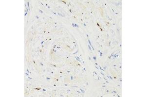 Immunohistochemistry of paraffin-embedded human breast cancer using GEMIN2 Antibody. (SIP1 抗体)
