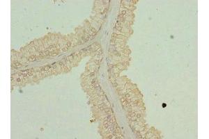 Immunohistochemistry of paraffin-embedded human prostate cancer using ABIN7162351 at dilution of 1:100 (GPR68 抗体  (AA 276-365))