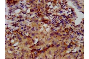 IHC image of ABIN7153231 diluted at 1:400 and staining in paraffin-embedded human ovarian cancer performed on a Leica BondTM system. (FKRP 抗体  (AA 28-140))