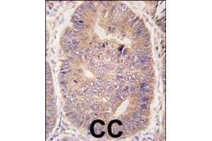 Formalin-fixed and paraffin-embedded human colon carcinoma tissue reacted with hTASP1-C-term (ABIN388126 and ABIN2846334) , which was peroxidase-conjugated to the secondary antibody, followed by DAB staining. (TASP1 抗体  (C-Term))