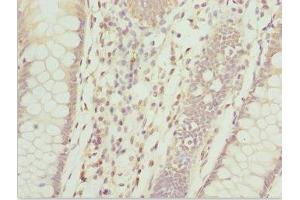 Immunohistochemistry of paraffin-embedded human colon cancer using ABIN7144060 at dilution of 1:100 (ZFAND3 抗体  (AA 1-227))