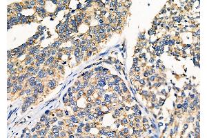 ABIN6259981 and ABIN6276533 at 1/100 staining Human ovarian cancer by IHC-P. (APOA1 抗体  (N-Term))