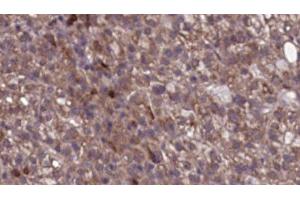 ABIN6276742 at 1/100 staining Human liver cancer tissue by IHC-P.