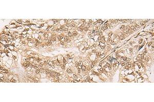 Immunohistochemistry of paraffin-embedded Human gastric cancer tissue using WEE1 Polyclonal Antibody at dilution of 1:35(x200) (WEE1 抗体)