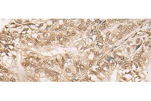 Immunohistochemistry of paraffin-embedded Human gastric cancer tissue using WEE1 Polyclonal Antibody at dilution of 1:35(x200)