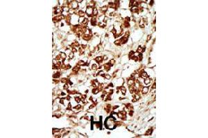 Formalin-fixed and paraffin-embedded human hepatocellular carcinoma tissue reacted with MLKLAK polyclonal antibody  , which was peroxidase-conjugated to the secondary antibody, followed by AEC staining. (ZAK 抗体  (Internal Region))