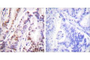 Peptide - +Immunohistochemical analysis of paraffin-embedded human lung carcinoma tissue using HDAC9 antibody (#C0228). (HDAC9 抗体)