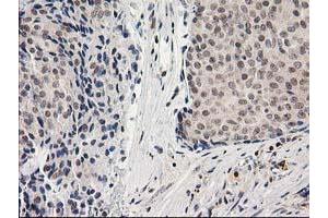 Immunohistochemical staining of paraffin-embedded Adenocarcinoma of Human breast tissue using anti-ADH1B mouse monoclonal antibody. (ADH1B 抗体)