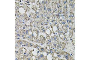 Immunohistochemistry of paraffin-embedded human liver injury using GFPT1 antibody. (GFPT1 抗体  (AA 1-150))