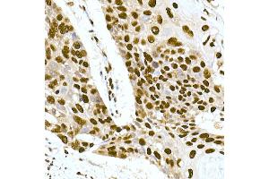 Immunohistochemistry of paraffin-embedded human esophageal cancer using DNA-PKcs Rabbit mAb (ABIN7269665) at dilution of 1:100 (40x lens). (PRKDC 抗体)