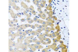 Immunohistochemistry of paraffin-embedded Human liver damage using M6PR Polyclonal Antibody at dilution of 1:100 (40x lens). (M6PR 抗体)