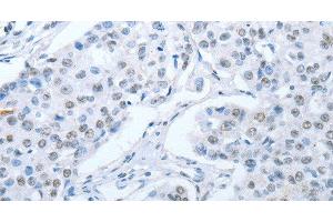 Immunohistochemistry of paraffin-embedded Human breast cancer tissue using ARHGEF2 Polyclonal Antibody at dilution 1:30 (ARHGEF2 抗体)