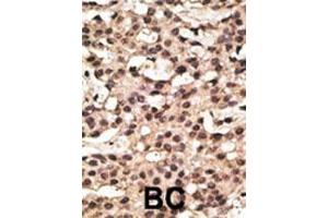 Formalin-fixed and paraffin-embedded human cancer tissue reacted with the primary antibody, which was peroxidase-conjugated to the secondary antibody, followed by DAB staining. (ATG9A 抗体  (AA 252-281))