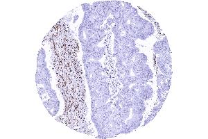 Colorectal carcinoma lacking GR staining in tumor cells while staining is strong in stromal cells
