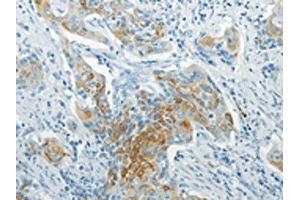 The image on the left is immunohistochemistry of paraffin-embedded Human cervical cancer tissue using ABIN7193069(WNT8B Antibody) at dilution 1/20, on the right is treated with synthetic peptide. (WNT8B 抗体)