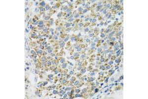 Immunohistochemistry of paraffin-embedded human lung cancer using TXN2 antibody (ABIN5974110) at dilution of 1/100 (40x lens). (TXN2 抗体)