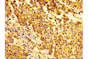 Immunohistochemistry of paraffin-embedded human colon cancer using ABIN7156373 at dilution of 1:100 (IGFBP6 抗体  (AA 32-161))