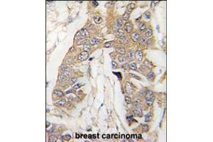 Formalin-fixed and paraffin-embedded human breast carcinoma tissue reacted with CASC3 Antibody , which was peroxidase-conjugated to the secondary antibody, followed by DAB staining. (CASC3 抗体  (C-Term))