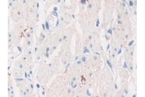 Detection of TPPP in Human Stomach cancer Tissue using Polyclonal Antibody to Tubulin Polymerization Promoting Protein (TPPP)