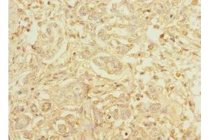 Immunohistochemistry of paraffin-embedded human pancreatic cancer using ABIN7155071 at dilution of 1:100 (Hephaestin 抗体  (AA 300-580))