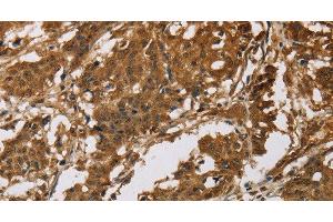 Immunohistochemistry of paraffin-embedded Human gastric cancer tissue using IL19 Polyclonal Antibody at dilution 1:40 (IL-19 抗体)