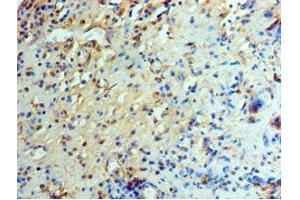 Immunohistochemistry of paraffin-embedded human prostate cancer using ABIN7151466 at dilution of 1:100 (GCN2 抗体  (AA 1-300))