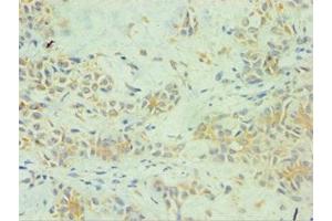 Immunohistochemistry of paraffin-embedded human breast cancer using ABIN7157738 at dilution of 1:100