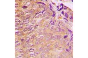 Immunohistochemical analysis of GRB10 staining in human breast cancer formalin fixed paraffin embedded tissue section. (GRB10 抗体  (N-Term))