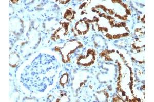 FFPE human renal cell carcinoma tested with MFGE8 antibody (MFG-06)
